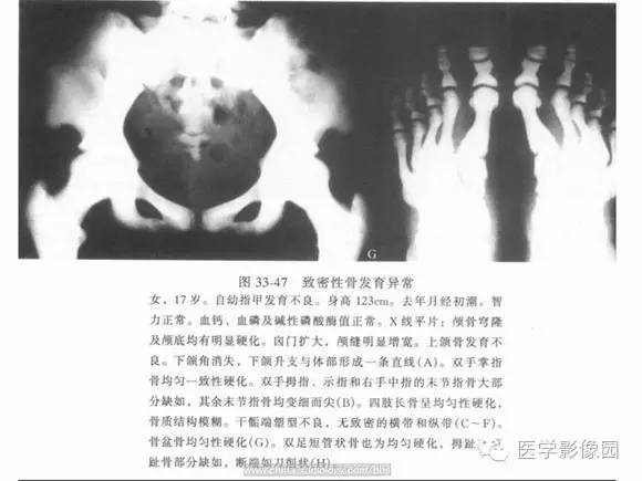 【PPT】骨与软骨发育异常