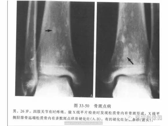 【PPT】骨与软骨发育异常