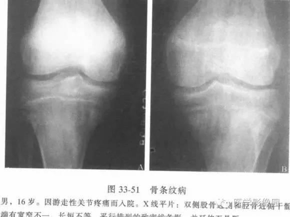 【PPT】骨与软骨发育异常