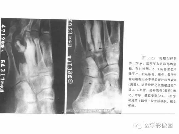 【PPT】骨与软骨发育异常