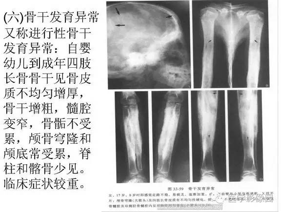 【PPT】骨与软骨发育异常
