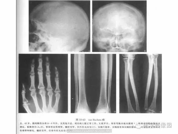 【PPT】骨与软骨发育异常