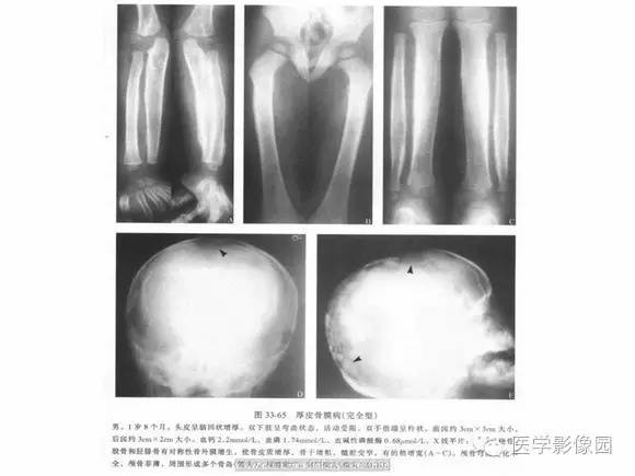【PPT】骨与软骨发育异常