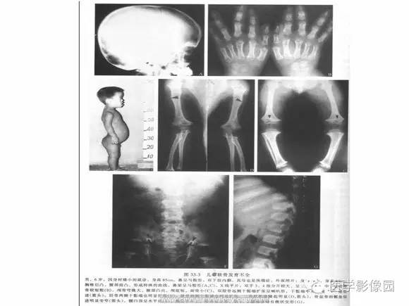 【PPT】骨与软骨发育异常