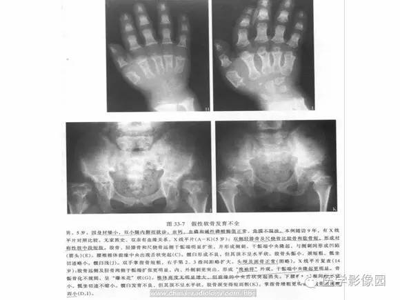 【PPT】骨与软骨发育异常