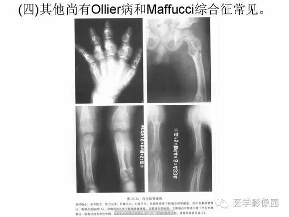 【PPT】骨与软骨发育异常