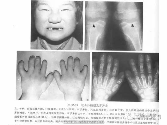 【PPT】骨与软骨发育异常