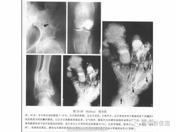 【PPT】骨与软骨发育异常