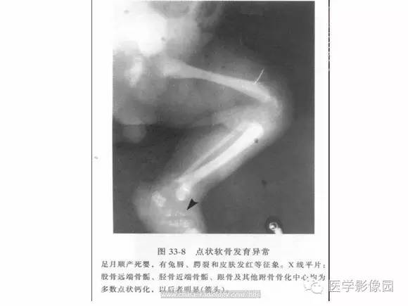 【PPT】骨与软骨发育异常