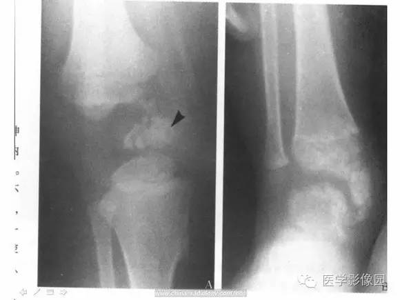 【PPT】骨与软骨发育异常