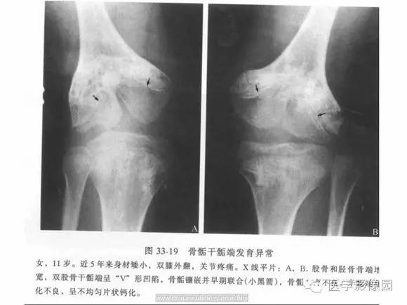 【PPT】骨与软骨发育异常