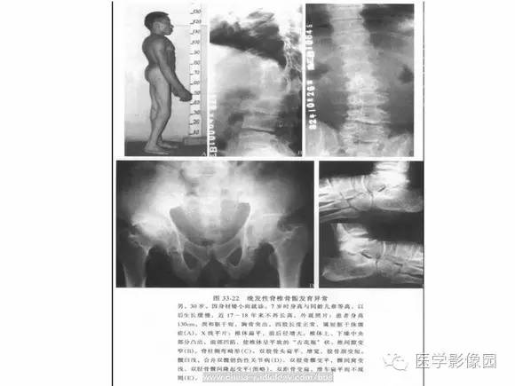 【PPT】骨与软骨发育异常