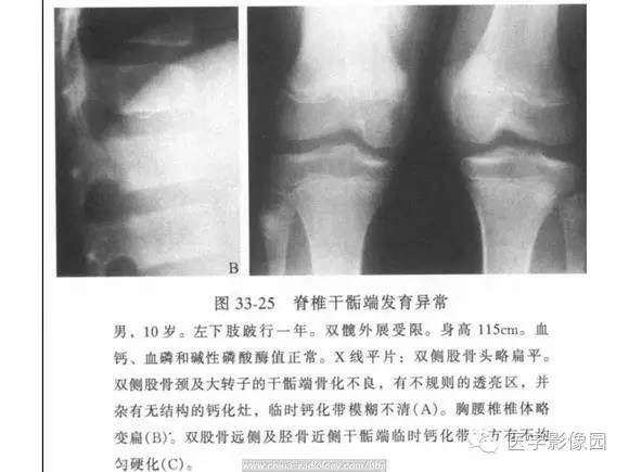 【PPT】骨与软骨发育异常
