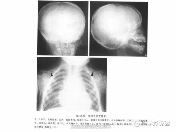 【PPT】骨与软骨发育异常