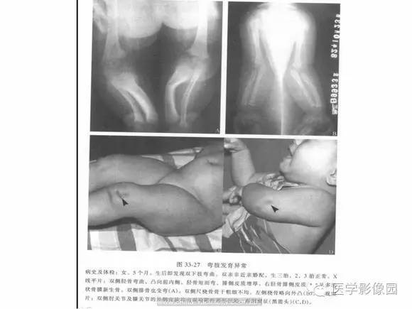 【PPT】骨与软骨发育异常