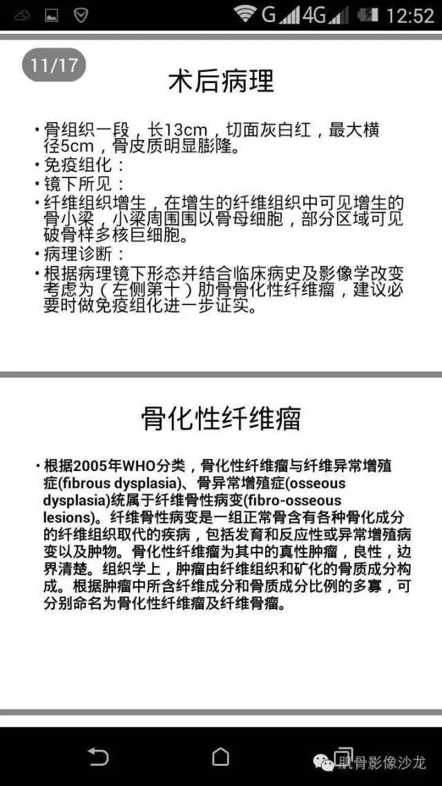 【病例】肋骨骨化性纤维瘤一例CT病例讨论