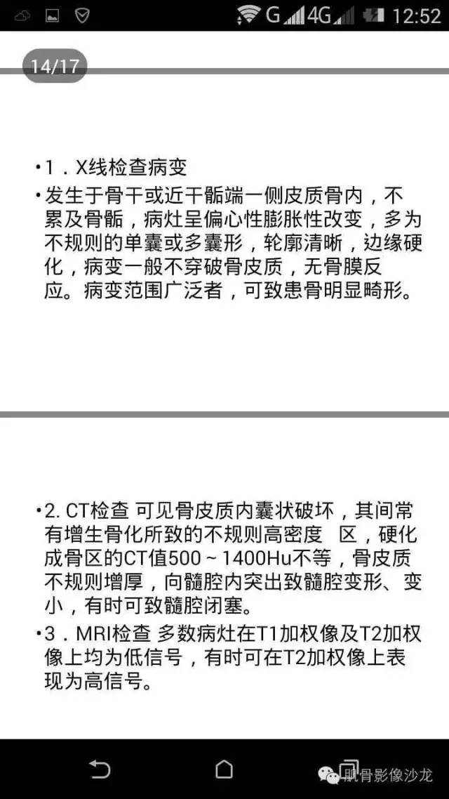 【病例】肋骨骨化性纤维瘤一例CT病例讨论