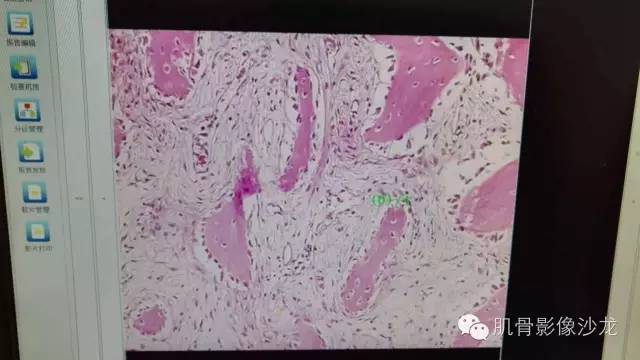 【病例】肋骨骨化性纤维瘤一例CT病例讨论
