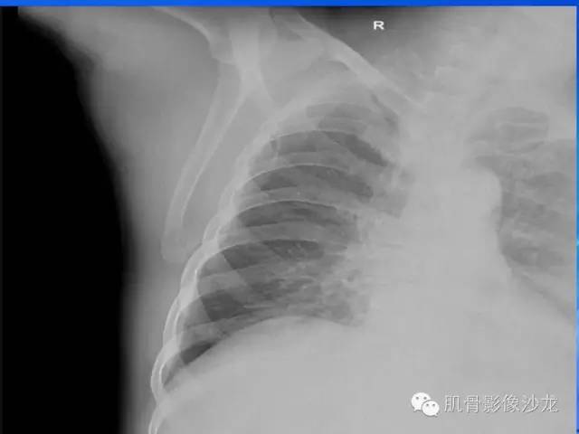 【病例】骨外骨肉瘤1例X线MR