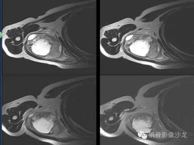 【病例】骨外骨肉瘤1例X线MR