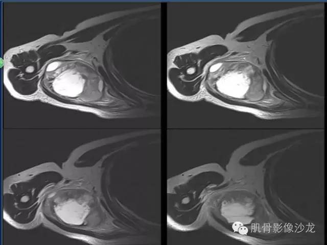 【病例】骨外骨肉瘤1例X线MR