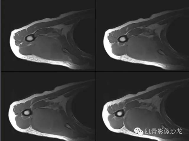 【病例】骨外骨肉瘤1例X线MR