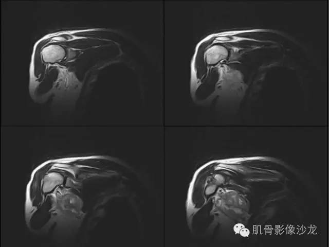 【病例】骨外骨肉瘤1例X线MR