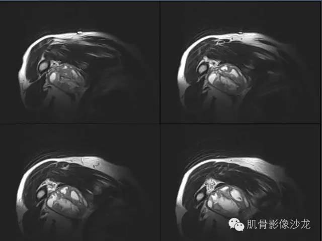 【病例】骨外骨肉瘤1例X线MR