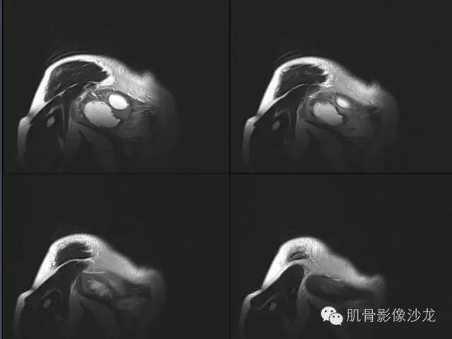 【病例】骨外骨肉瘤1例X线MR