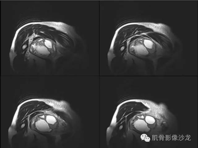 【病例】骨外骨肉瘤1例X线MR