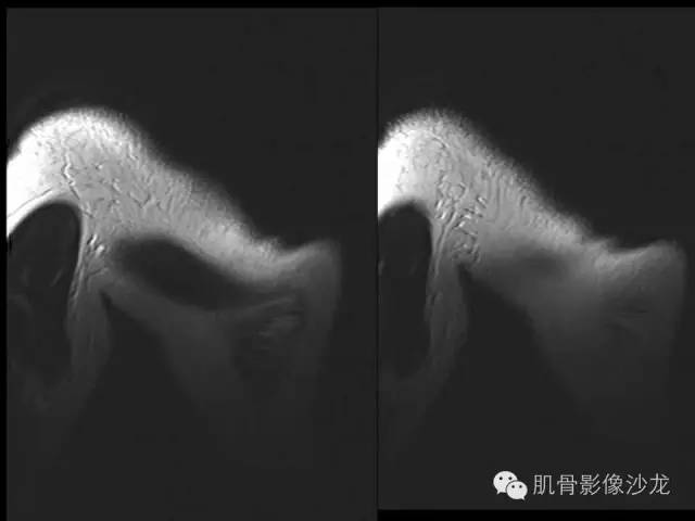 【病例】骨外骨肉瘤1例X线MR