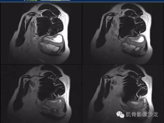 【病例】骨外骨肉瘤1例X线MR