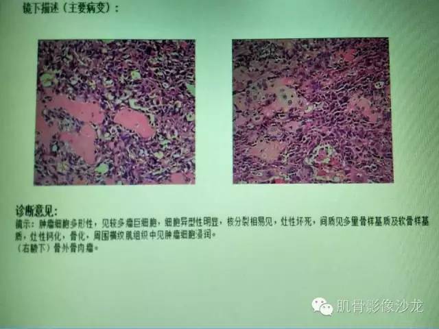 【病例】骨外骨肉瘤1例X线MR