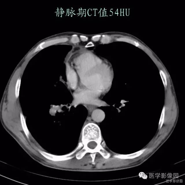 【病例】肺癌伴癌性淋巴管炎1例CT影像表现 【病例】肺癌伴癌性淋巴管炎1例CT影像表现