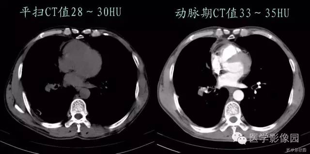 【病例】肺癌伴癌性淋巴管炎1例CT影像表现