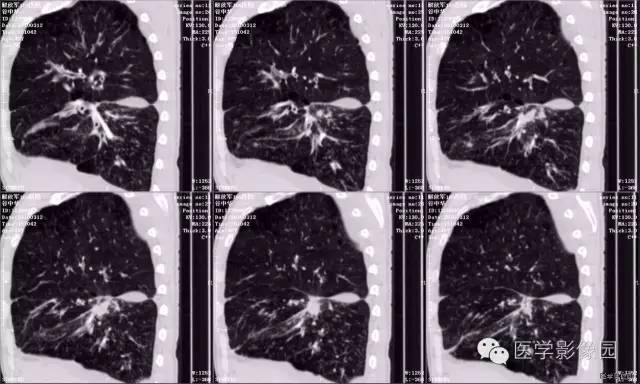 【病例】肺癌伴癌性淋巴管炎1例CT影像表现 【病例】肺癌伴癌性淋巴管炎1例CT影像表现