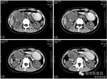 【病例】胰腺实性假乳头状瘤1例CT影像表现