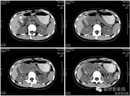 【病例】胰腺实性假乳头状瘤1例CT影像表现 【病例】胰腺实性假乳头状瘤1例CT影像表现