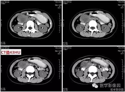 【病例】胰腺实性假乳头状瘤1例CT影像表现 【病例】胰腺实性假乳头状瘤1例CT影像表现