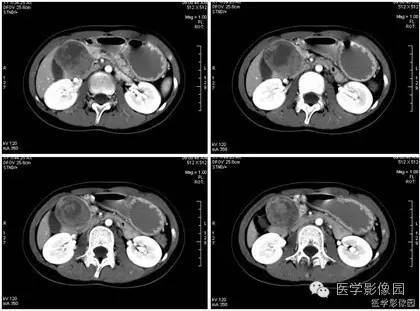 【病例】胰腺实性假乳头状瘤1例CT影像表现 【病例】胰腺实性假乳头状瘤1例CT影像表现