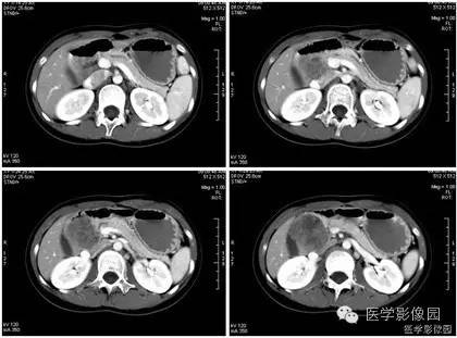 【病例】胰腺实性假乳头状瘤1例CT影像表现 【病例】胰腺实性假乳头状瘤1例CT影像表现