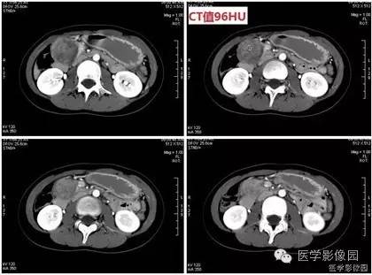 【病例】胰腺实性假乳头状瘤1例CT影像表现 【病例】胰腺实性假乳头状瘤1例CT影像表现