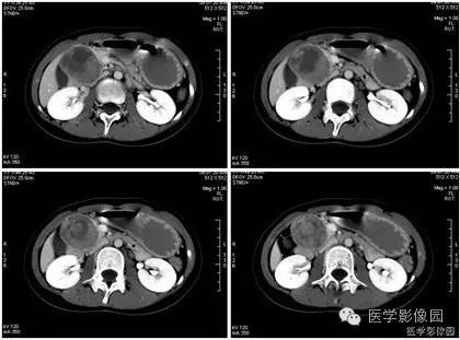【病例】胰腺实性假乳头状瘤1例CT影像表现 【病例】胰腺实性假乳头状瘤1例CT影像表现
