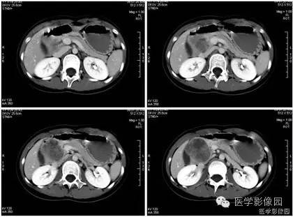 【病例】胰腺实性假乳头状瘤1例CT影像表现 【病例】胰腺实性假乳头状瘤1例CT影像表现