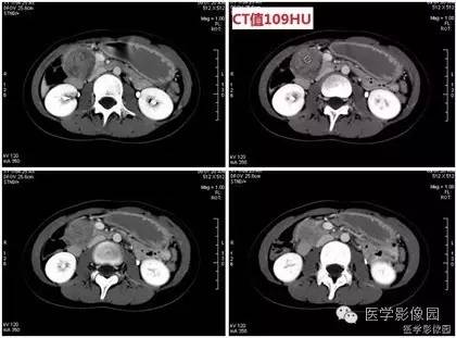 【病例】胰腺实性假乳头状瘤1例CT影像表现 【病例】胰腺实性假乳头状瘤1例CT影像表现