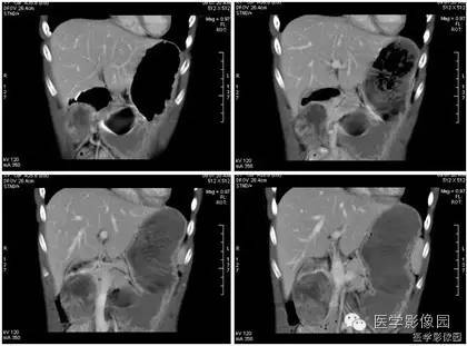 【病例】胰腺实性假乳头状瘤1例CT影像表现 【病例】胰腺实性假乳头状瘤1例CT影像表现