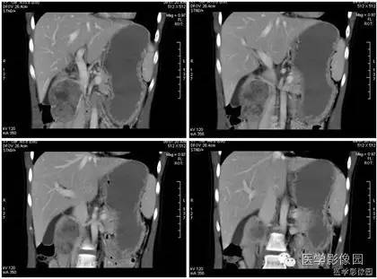 【病例】胰腺实性假乳头状瘤1例CT影像表现 【病例】胰腺实性假乳头状瘤1例CT影像表现
