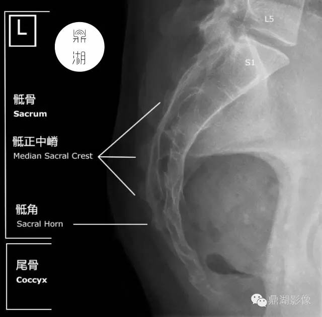 骶骨X线解剖