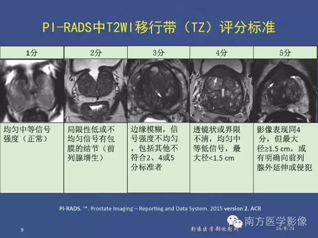 【PPT】前列腺影像报告和数据系统