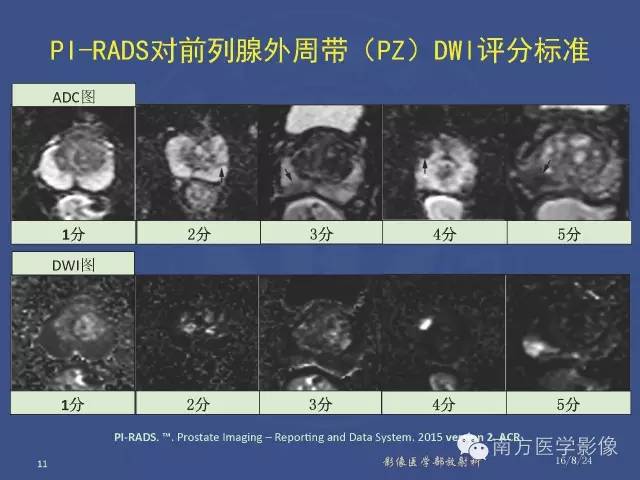 【PPT】前列腺影像报告和数据系统
